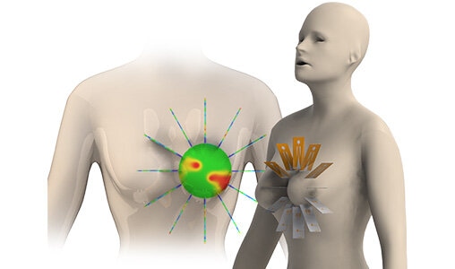 http://mail.emworks.com/blog/hfworks/an-antenna-simulator-to-study-microwave-hyperthermia-for-breast-cancer-treatment